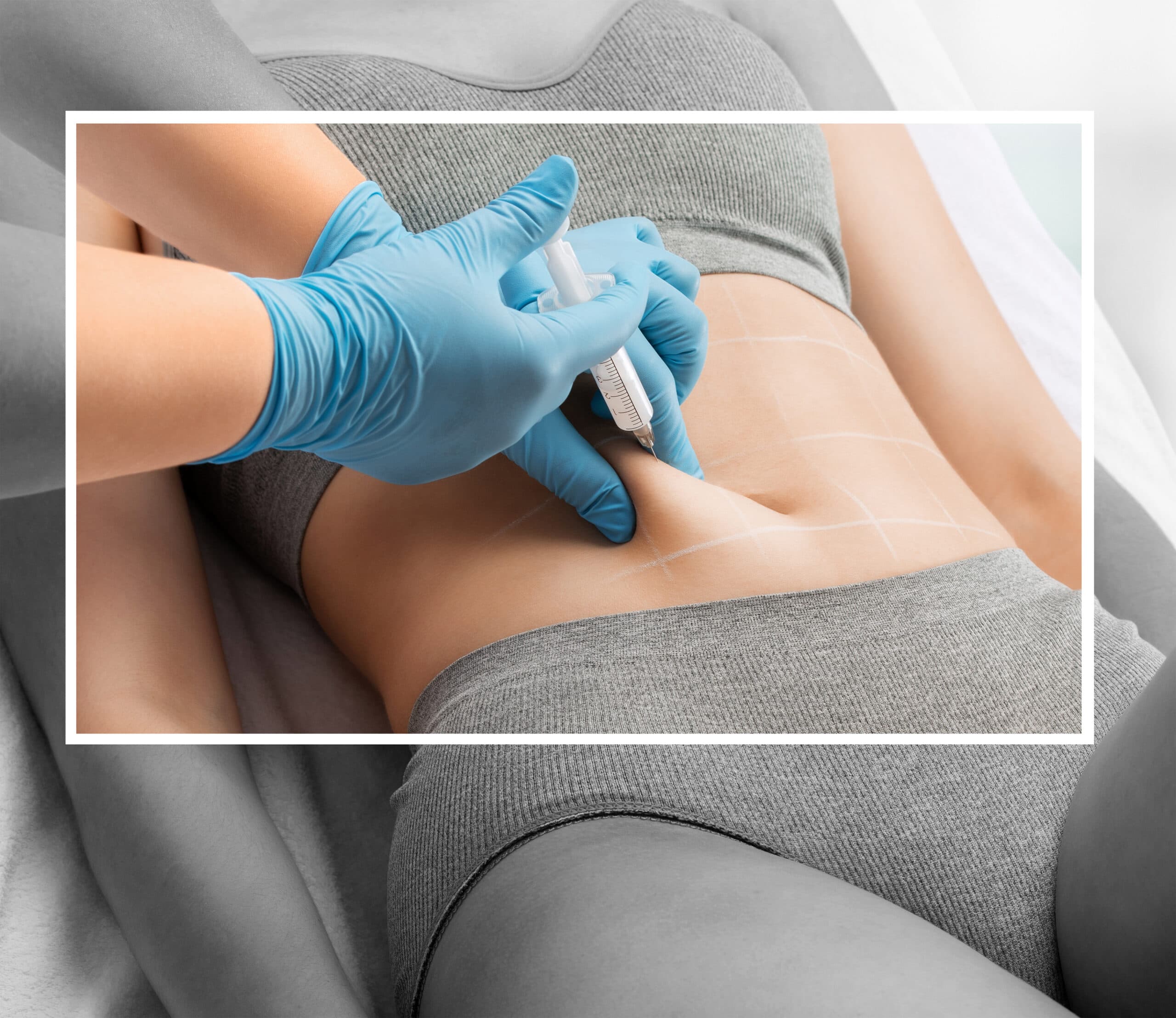 Injektionslipolyse-Behandlung am Bauch